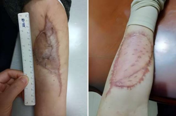 方舟配资 上海医院创新“双阶段真皮移植术”治疗复发性肉瘤